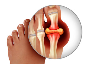 Got Gout? Find Out.